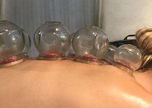 Cuppingbehandling i Aarhus